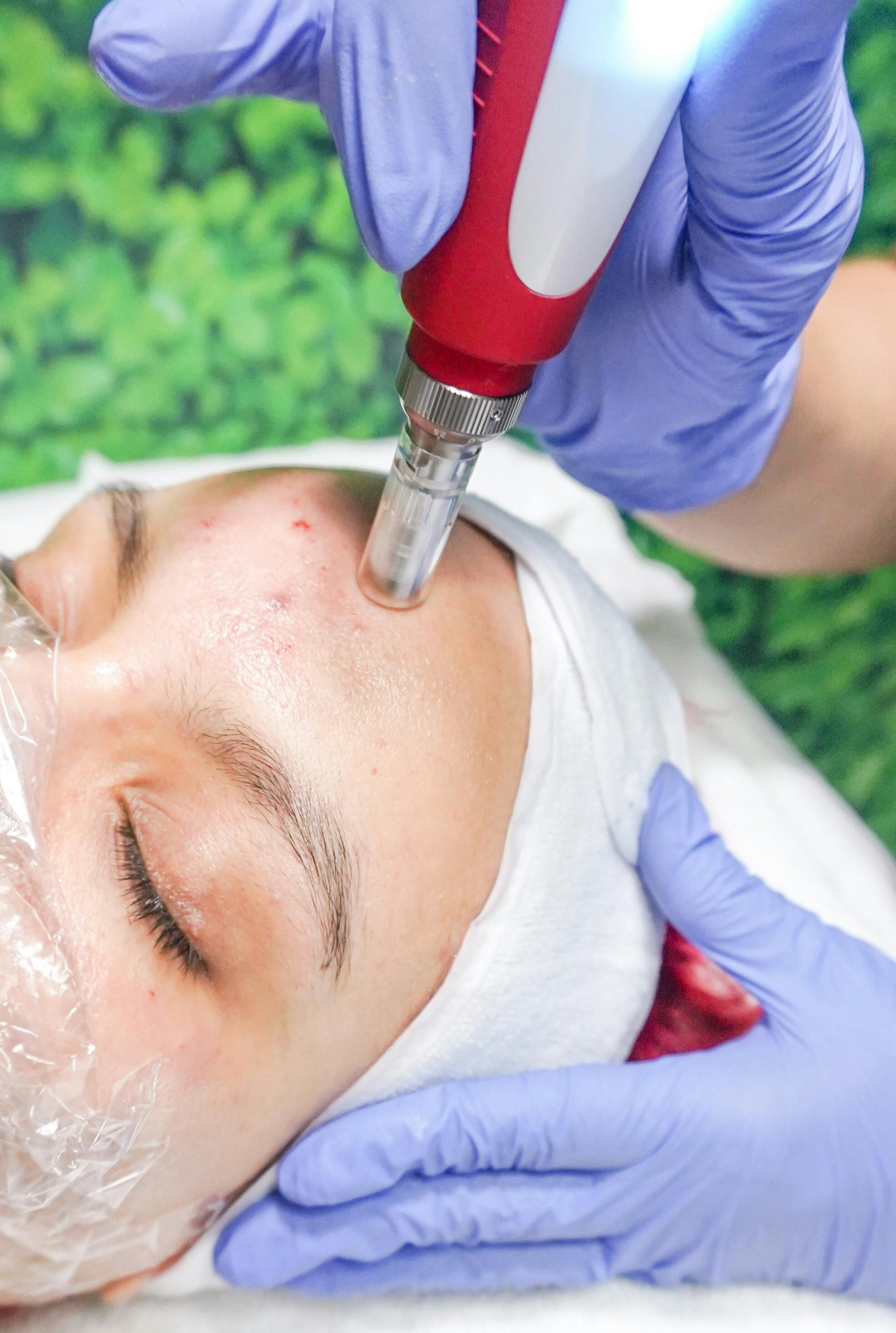 Dermapen